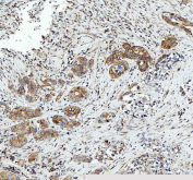 IHC staining of FFPE human appendix mucinous adenocarcinoma tissue with Heme Oxygenase 2 antibody. HIER: boil tissue sections in pH8 EDTA buffer for 20 min and allow to cool before testing.