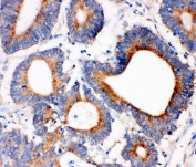 IHC-P: IRS1 antibody testing of human intestinal cancer tissue