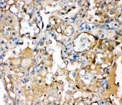 IHC-P: BK channel antibody testing of human lung cancer tissue