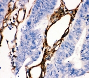 IHC staining of FFPE human intestinal cancer tissue with HSP27 antibody. HIER: boil tissue sections in pH6, 10mM citrate buffer, for 10-20 min and allow to cool before testing.