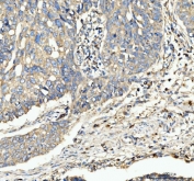 IHC staining of FFPE human bladder urothelial carcinoma tissue with CD63 antibody. HIER: boil tissue sections in pH8 EDTA for 20 min and allow to cool before testing.