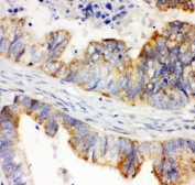 IHC-P: HIF-1 alpha antibody testing of human intestinal cancer tissue