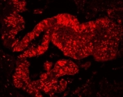 Immunofluorescent staining of FFPE human colon cancer tissue with MCM7 antibody. HIER: steam section in pH6 citrate buffer for 20 min.