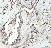 IHC staining of FFPE human pancreas cancer tissue with c-Myb antibody. HIER: boil tissue sections in pH8 EDTA for 20 min and allow to cool before testing.