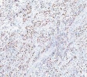 IHC staining of FFPE human bladder tissue with PARP antibody. HIER: boil tissue sections in pH8 EDTA for 20 min and allow to cool before testing.