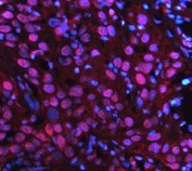 Immunofluorescent staining of FFPE human bladder cancer tissue with PARP antibody (red) and DAPI nuclear stain (blue). HIER: steam section in pH8 EDTA buffer for 20 min.