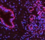 Immunofluorescent staining of FFPE human pancreas cancer tissue with PARP antibody (red) and DAPI nuclear stain (blue). HIER: steam section in pH8 EDTA buffer for 20 min.