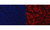 Immunofluorescent staining of FFPE human breast cancer tissue with PARP antibody (red) and DAPI nuclear stain (blue). HIER: steam section in pH8 EDTA buffer for 20 min.
