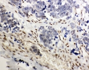 IHC-P: GR antibody testing of human lung cancer tissue