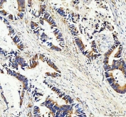 IHC staining of FFPE human colon cancer tissue with SERPINB5 antibody. HIER: boil tissue sections in pH8 EDTA for 20 min and allow to cool before testing.