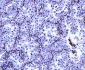 IHC staining of FFPE human lung adenocarcinoma tissue with Vimentin antibody. HIER: boil tissue sections in pH8 EDTA for 20 min and allow to cool before testing.