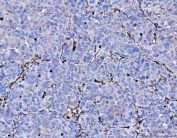 IHC staining of FFPE human liver cancer tissue with Vimentin antibody. HIER: boil tissue sections in pH8 EDTA for 20 min and allow to cool before testing.