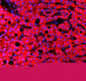 Immunofluorescent staining of FFPE human liver cancer tissue with RBP4 antibody (red) and DAPI nuclear stain (blue). HIER: steam section in pH8 EDTA buffer for 20 min.