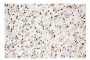 IHC staining of FFPE human glioma tissue with VCP antibody. HIER: boil tissue sections in pH8 EDTA for 20 min and allow to cool before testing.