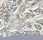 IHC staining of FFPE human lung cancer tissue with CCN1 antibody, HRP-secondary and DAB substrate. HIER: boil tissue sections in pH8 EDTA for 20 min and allow to cool before testing.