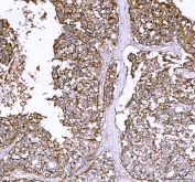 IHC staining of FFPE human liver cancer tissue with ATP1A1 antibody. HIER: boil tissue sections in pH8 EDTA for 20 min and allow to cool before testing.