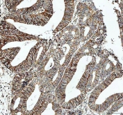 IHC staining of FFPE human endometrioid adenocarcinoma tissue with ATP1A1 antibody. HIER: boil tissue sections in pH8 EDTA for 20 min and allow to cool before testing.