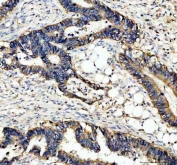 IHC staining of FFPE human colon cancer tissue with ATP1A1 antibody. HIER: boil tissue sections in pH8 EDTA for 20 min and allow to cool before testing.