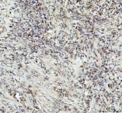 IHC staining of FFPE human lung squamous cell carcinoma tissue with G-CSF antibody. HIER: boil tissue sections in pH8 EDTA for 20 min and allow to cool before testing.