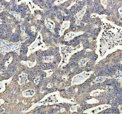 IHC staining of FFPE human stomach cancer tissue with MGST1 antibody. HIER: boil tissue sections in pH8 EDTA for 20 min and allow to cool before testing.
