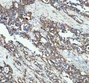 IHC staining of FFPE human pancreas cancer tissue with MGST1 antibody. HIER: boil tissue sections in pH8 EDTA for 20 min and allow to cool before testing.