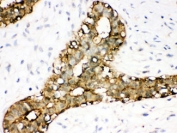 IHC testing of FFPE human breast cancer with Annexin A3 antibody. HIER: Boil the paraffin sections in pH 6, 10mM citrate buffer for 20 minutes and allow to cool prior to staining.