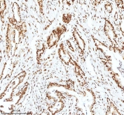 IHC staining of FFPE human pancreas ductal adenocarcinoma tissue with Ku70 antibody. HIER: boil tissue sections in pH8 EDTA for 20 min and allow to cool before testing.