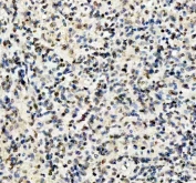IHC staining of FFPE human glioblastoma tissue with LMNB1 antibody. HIER: boil tissue sections in pH8 EDTA for 20 min and allow to cool before testing.