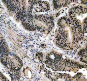 IHC staining of FFPE human colon cancer tissue with Cyclin D1 antibody, HRP-secondary and DAB substrate. HIER: boil tissue sections in pH8 EDTA for 20 min and allow to cool before testing.
