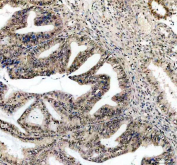 IHC staining of FFPE human endometrial cancer tissue with Cyclin D1 antibody, HRP-secondary and DAB substrate. HIER: boil tissue sections in pH8 EDTA for 20 min and allow to cool before testing.