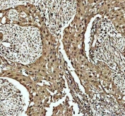 IHC staining of FFPE human invasive urothelial carcinoma of the bladder with squamous differentiation tissue with Cdk2 antibody. HIER: boil tissue sections in pH8 EDTA for 20 min and allow to cool before testing.