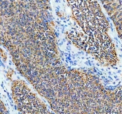 IHC staining of FFPE human ovarian cancer tissue with SDHA antibody. HIER: boil tissue sections in pH8 EDTA for 20 min and allow to cool before testing.