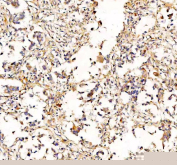 IHC staining of FFPE human breast cancer tissue with RAB14 antibody, HRP-labeled secondary and DAB substrate. HIER: boil tissue sections in pH8 EDTA for 20 min and allow to cool before testing.