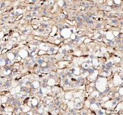 IHC staining of FFPE human liver cancer tissue with Actin antibody. HIER: Boil the paraffin sections in pH8 EDTA buffer for 20 minutes and allow to cool prior to staining.