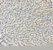 IHC staining of FFPE human liver cancer tissue with mtTFA antibody, HRP-labeled secondary and DAB substrate. HIER: boil tissue sections in pH8 EDTA for 20 min and allow to cool before testing.