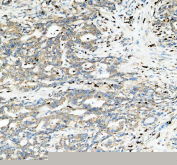 IHC staining of FFPE human pancreas cancer tissue with mtTFA antibody, HRP-labeled secondary and DAB substrate. HIER: boil tissue sections in pH8 EDTA for 20 min and allow to cool before testing.