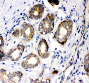 IHC staining of FFPE human breast cancer tissue with FAK antibody, HRP-secondary and DAB substrate. HIER: boil tissue sections in pH8 EDTA for 20 min and allow to cool before testing.