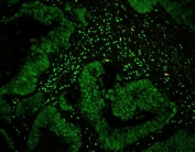 Immunofluorescent staining of FFPE human intestinal cancer tissue with CTBP1 antibody. HIER: steam section in pH6 citrate buffer for 20 min.