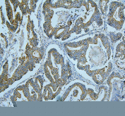 IHC staining of FFPE human intestinal cancer tissue with ALIX antibody. HIER: boil tissue sections in pH8 EDTA buffer for 20 min and allow to cool before testing.