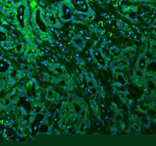 Immunofluorescent staining of FFPE human pancreatic cancer tissue with ALIX antibody (green) and DAPI nuclear stain (blue). HIER: steam section in pH8 EDTA buffer for 20 min.