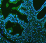 Immunofluorescent staining of FFPE human prostate cancer tissue with ALIX antibody (green) and DAPI nuclear stain (blue). HIER: steam section in pH8 EDTA buffer for 20 min.