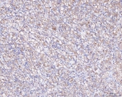 IHC staining of FFPE human glioma tissue with ATX2 antibody. HIER: boil tissue sections in pH8 EDTA for 20 min and allow to cool before testing.