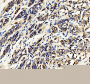 IHC staining of FFPE human breast cancer tissue with HDAC6 antibody, HRP-secondary and DAB substrate. HIER: boil tissue sections in pH8 EDTA for 20 min and allow to cool before testing.
