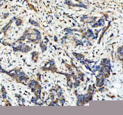 IHC staining of FFPE human breast cancer tissue with HDAC6 antibody, HRP-secondary and DAB substrate. HIER: boil tissue sections in pH8 EDTA for 20 min and allow to cool before testing.