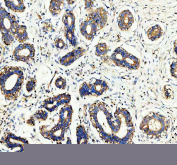 IHC staining of FFPE human breast cancer tissue with WDR1 antibody, HRP-secondary and DAB substrate. HIER: boil tissue sections in pH8 EDTA for 20 min and allow to cool before testing.