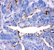 IHC staining of FFPE human intestinal cancer tissue with Adenosine deaminase antibody. HIER: boil tissue sections in pH8 EDTA for 20 min and allow to cool before testing.