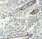 IHC staining of FFPE human colorectal adenocarcinoma tissue with GIP antibody. HIER: boil tissue sections in pH8 EDTA for 20 min and allow to cool before testing.