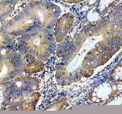IHC staining of FFPE human colon cancer tissue with Perilipin 3 antibody, HRP-secondary and DAB substrate. HIER: boil tissue sections in pH8 EDTA for 20 min and allow to cool before testing.