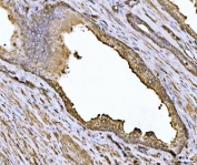 IHC staining of FFPE human prostate cancer tissue with ACTN4 antibody. HIER: boil tissue sections in pH8 EDTA for 20 min and allow to cool before testing.