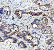 IHC staining of FFPE human stomach cancer tissue with AMACR antibody. HIER: boil tissue sections in pH8 EDTA for 20 min and allow to cool before testing.